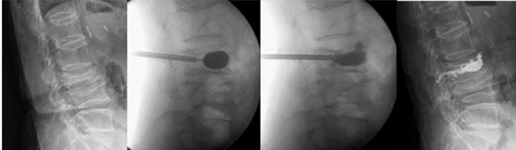 Kiphoplasty operation