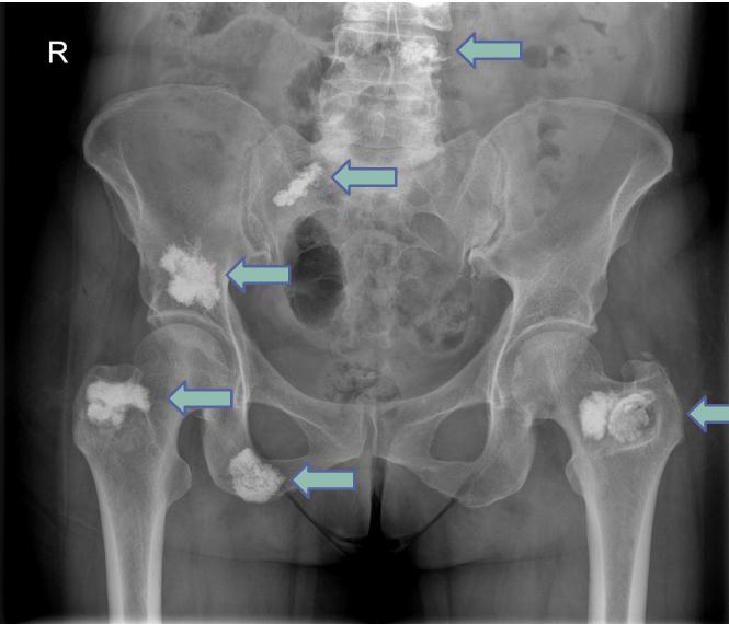 cementoplasty operation