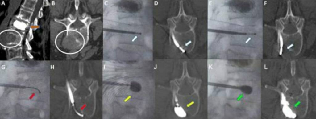 operation kiphoplasty