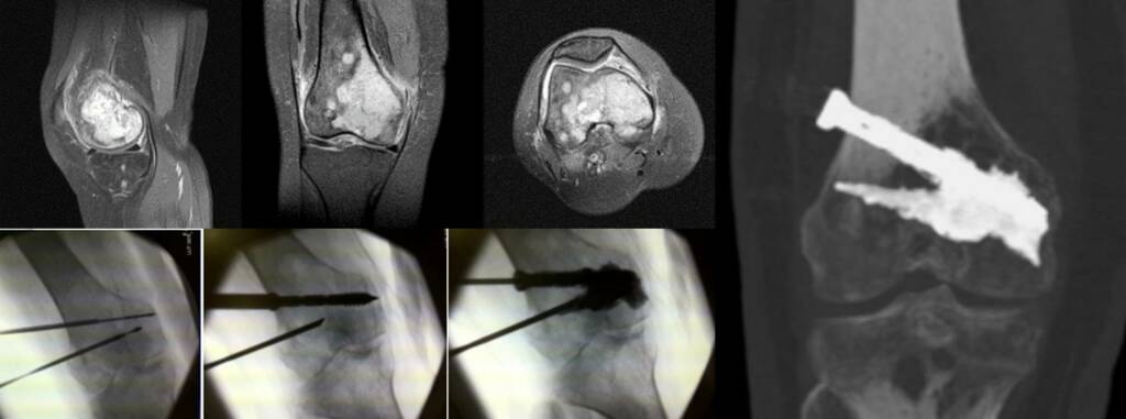 Percutaneous osteosynthesis