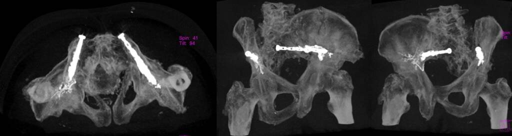 percutenaous osteosinthesys