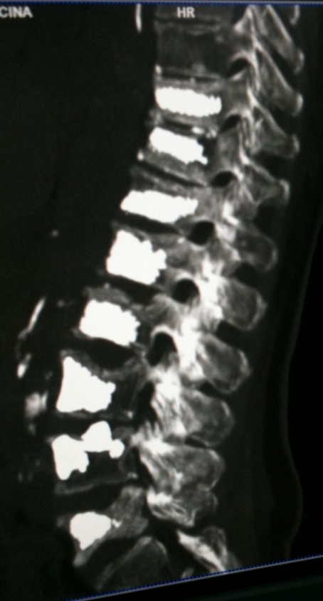 vertebral column